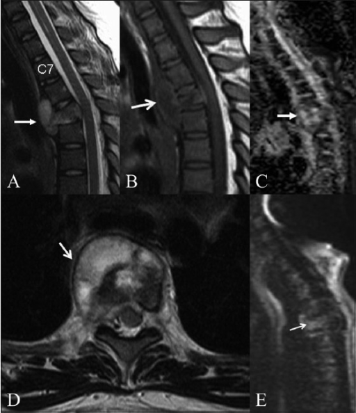Figure 9. Spinal tuberculosis - vertebral destruction with paravertebral/epidural extension (MRI). Palle et al., Indian J Radiol Imaging 2010, CC BY, via PMC.