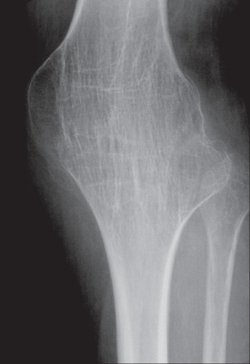 Figure 10. Tuberculous arthritis - bony ankylosis of the knee (a TB sequela). De Backer et al., Indian J Radiol Imaging 2009, CC BY, via PMC.
