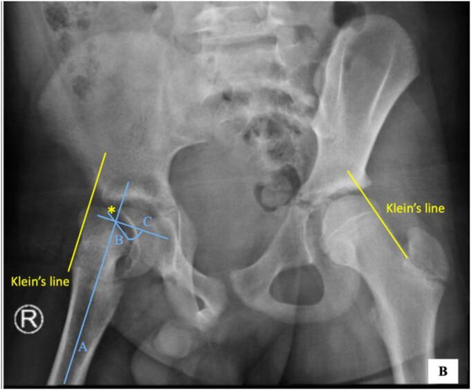 Severe (unstable) SCFE. Antero-posterior pelvis of a severe right-sided slip with marked posteroinferior displacement; Klein’s line is drawn on both sides (positive Trethowan on the right) and the slip angle is constructed. Kurniawan et al., Int J Surg Case Rep 2024;123:110264, Fig. 2 (CC BY 4.0).
