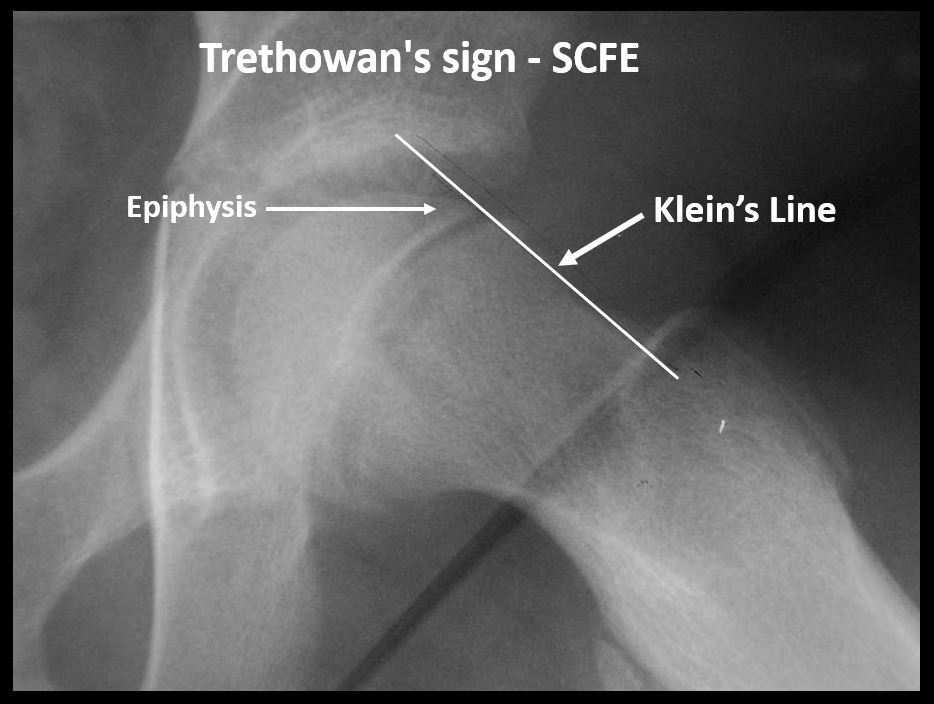 Klein’s line and the Trethowan sign. A line along the superior femoral neck normally clips the lateral epiphysis; here it passes above the slipped epiphysis (positive Trethowan sign). Dr. Vijaya Chandar, via Wikimedia Commons (CC0).