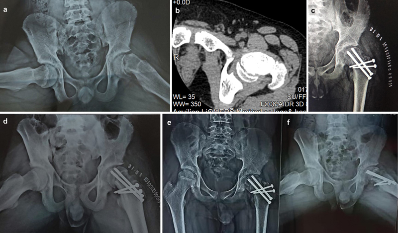 Modified Dunn realignment. A severe slip (a, with axial CT b and frog-lateral c) corrected by subcapital realignment through a surgical hip dislocation, fixed with cannulated screws (d-f). Bhuyan BK, Rev Bras Ortop 2024;59(6):e913-e921, Fig. 2 (CC BY 4.0).