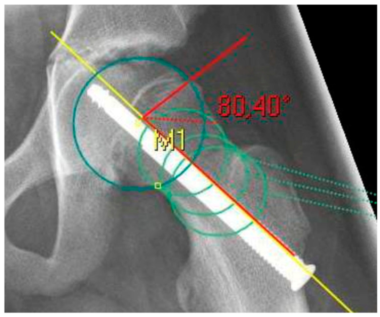 Residual cam deformity (femoroacetabular impingement). After a healed slip, the loss of head-neck offset gives a raised alpha angle (here 80.4°) - the cam morphology that drives impingement and early osteoarthritis. Wirries et al., Children (Basel) 2021;8(11):992, Fig. 1 (CC BY 4.0).