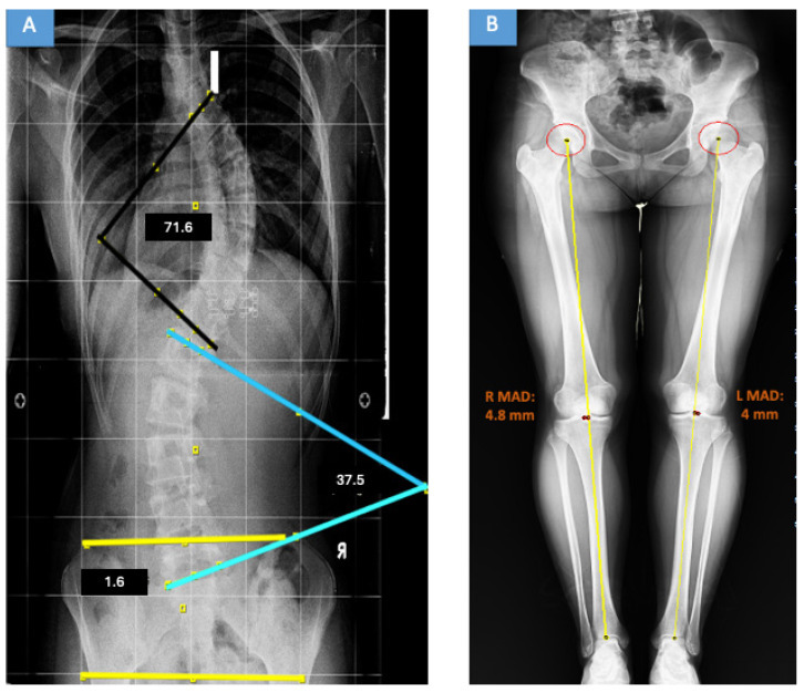 Lenke classification on a full-spine radiograph. Standing antero-posterior film of a Lenke 3C double-major curve with the Cobb angles drawn (main thoracic 71.6°, thoracolumbar/lumbar 37.5°). Aydın AS et al., Medicina (Kaunas) 2026;62(5):978, panel A (CC BY 4.0).