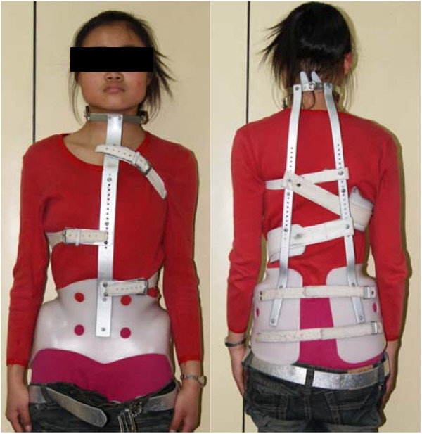 Milwaukee brace (CTLSO). The historical cervico-thoraco-lumbo-sacral orthosis, with a pelvic girdle and a superstructure carrying occipital and throat pads, now reserved for high thoracic curves. Jun Jiang et al., via Wikimedia Commons (CC BY 2.0; the patient’s face is redacted in the original).