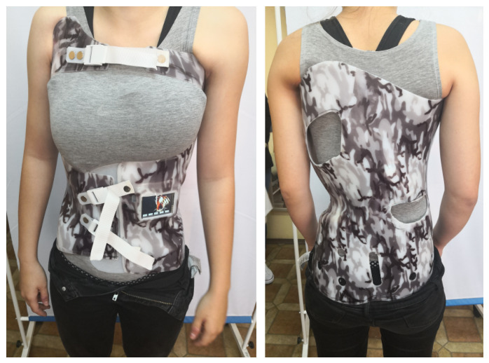 Boston-type underarm TLSO. The thoraco-lumbo-sacral orthosis is the most widely used brace for adolescent idiopathic scoliosis, applied to curves with an apex below T7. Tymińska-Wójcik P et al., Sensors (Basel) 2026;26(10):3169 (CC BY 4.0).