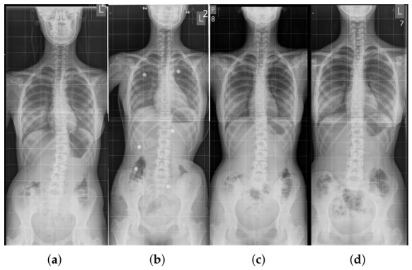 In-brace correction. Serial full-spine radiographs of an adolescent idiopathic curve - before bracing (a), in the brace with embedded sensors (b), at follow-up (c) and out of the brace (d) - illustrating that the brace holds the curve corrected during growth. Tymińska-Wójcik P et al., Sensors (Basel) 2026;26(10):3169 (CC BY 4.0).