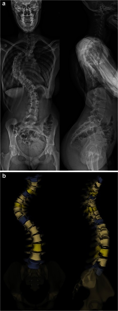 Adolescent idiopathic scoliosis in three planes. Standing antero-posterior and lateral radiographs (A) of a right thoracic / left lumbar curve, with the biplanar (EOS) three-dimensional reconstruction (B) showing the coupled lateral deviation, axial rotation and sagittal change. Amzallag-Bellenger E et al., Insights Imaging 2014;5:571-583 (CC BY 4.0).