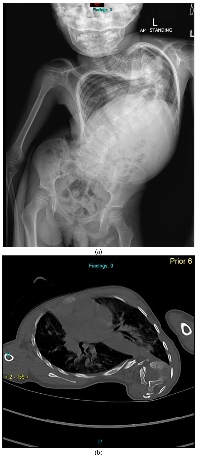 Infantile idiopathic scoliosis. Standing antero-posterior radiograph of a young child with a severe early-onset curve (A) and an axial chest CT (B) showing the marked apical vertebral rotation and chest-wall deformity that threaten lung development. Balasubramanian SG et al., J Clin Med 2026;15(2):754 (CC BY 4.0).