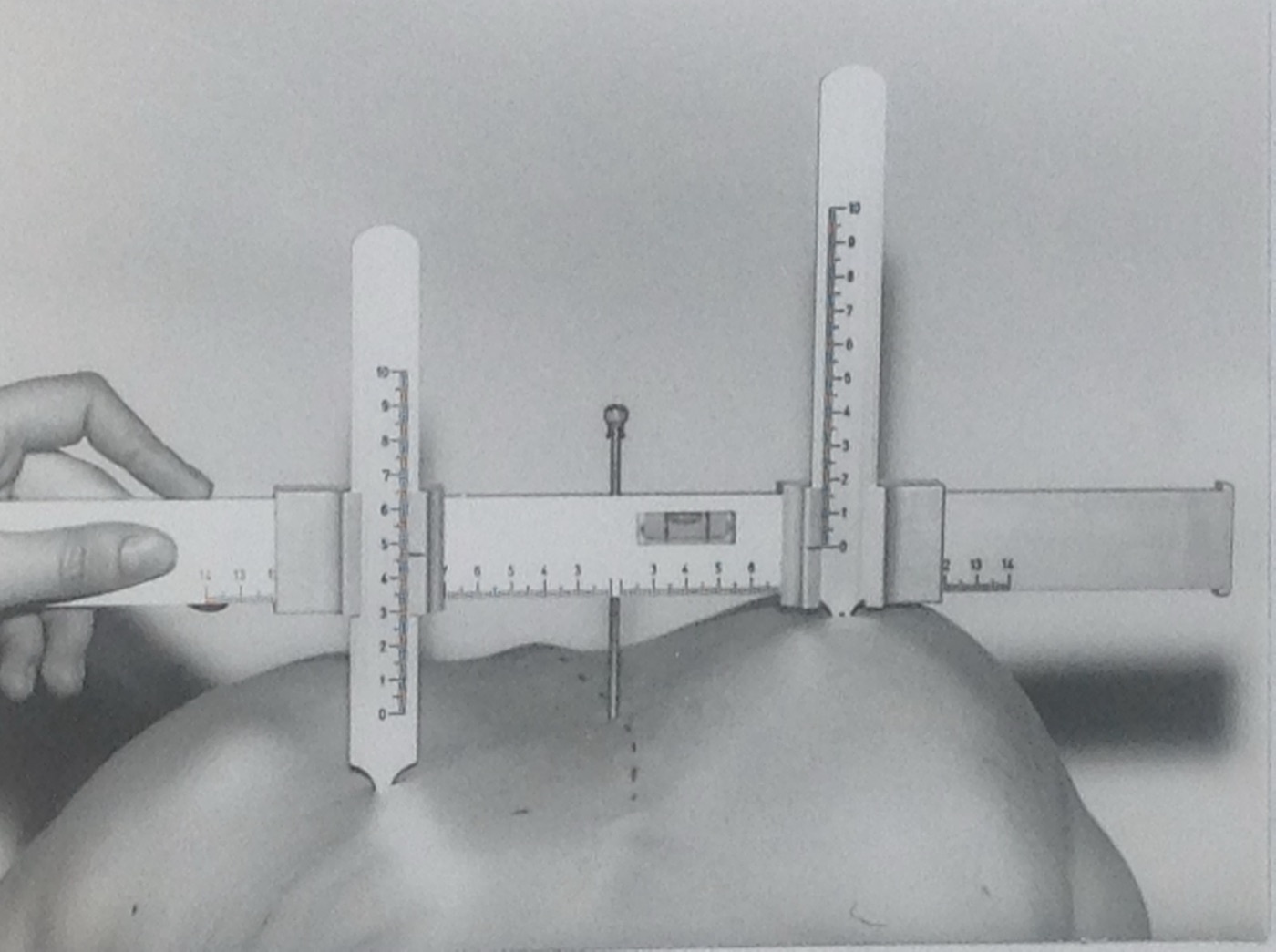 Scoliometer (inclinometer). The device is laid across the apex of the rib prominence with the patient bent forward to read the angle of trunk rotation; an angle of 7° or more prompts a screening radiograph. Hans-Günther Götze, via Wikimedia Commons (CC BY-SA 4.0).
