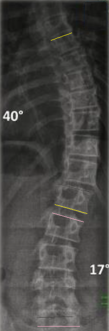 The Cobb method. Lines are drawn along the endplates of the upper and lower end vertebrae of each curve and perpendiculars erected; the angle of intersection is the Cobb angle (here 40° and 17°). Radiograph: Weiss HR, Seibel S, Kleban A; annotation by Mikael Häggström MD, via Wikimedia Commons (CC BY 4.0).