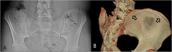 Risser sign. Antero-posterior pelvic radiograph (A) and three-dimensional CT (B) of the iliac crest apophysis, which ossifies from lateral to medial over 18-24 months and is graded 0-5 as an index of skeletal maturity. Yang JH et al., J Orthop Surg Res 2014;9:101 (CC BY 4.0).