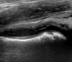 Figure 1. Hip ultrasound - fluid distending the anterior joint recess over the femoral neck (effusion). The key bedside test of the irritable hip; the effusion itself is non-specific (it occurs in both transient synovitis and sepsis). Ruiz Santiago et al., Radiol Res Pract 2016, CC BY 4.0, via Wikimedia Commons.
