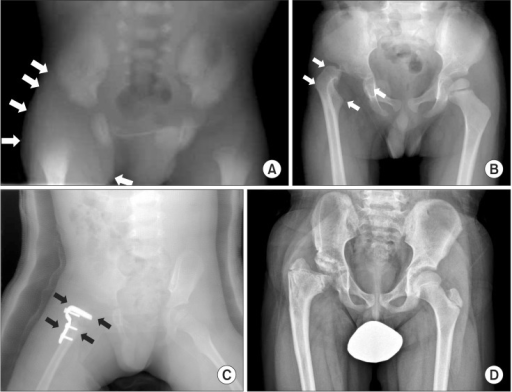 Figure 2. Infantile septic arthritis of the right hip and its sequelae: (A) neonatal peri-hip soft-tissue swelling; (B) pathological dislocation of the femoral head at 3 years; (C) reconstruction (varus-derotation osteotomy with arthroplasty); (D) follow-up at 10 years. Choi et al., Clin Orthop Surg 2015, CC BY-NC 3.0 (non-commercial), via PMC.