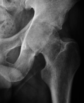 Figure 3. Septic arthritis - a destructive monoarticular process with peri-articular osteopenia (an adult hip, shown to illustrate the radiographic pattern). Ruiz Santiago et al., Radiol Res Pract 2016, CC BY 4.0, via Wikimedia Commons.