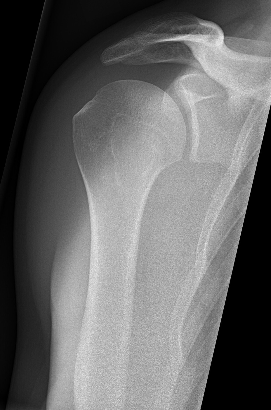 Figure 12. Normal shoulder radiograph in the AP glenoid (Grashey) projection, showing the humeral head congruent with the glenoid and an open joint space. Mikael Häggström, CC0, via Wikimedia Commons.