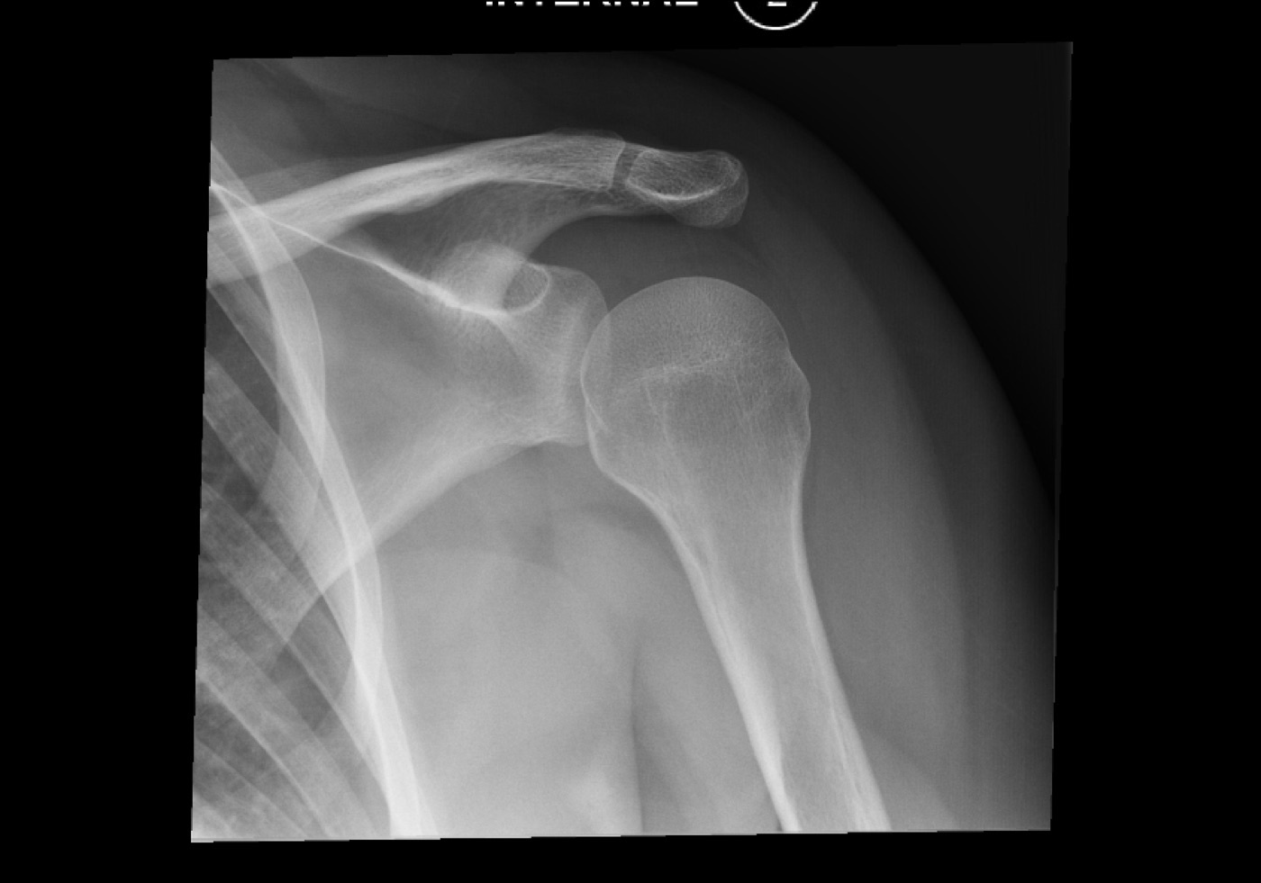 Figure 10. Hill-Sachs lesion on an AP internal-rotation radiograph: the posterolateral humeral-head impaction defect. Source: Andrew, via Wikimedia Commons, CC BY-SA 4.0.