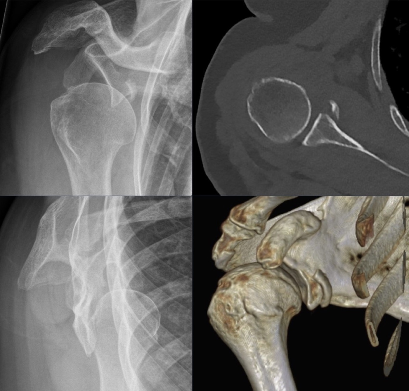 Figure 11. Bony Bankart lesion: an anteroinferior glenoid rim fracture on radiograph, CT, and 3D reconstruction. Source: Hellerhoff, via Wikimedia Commons, CC BY-SA 4.0.