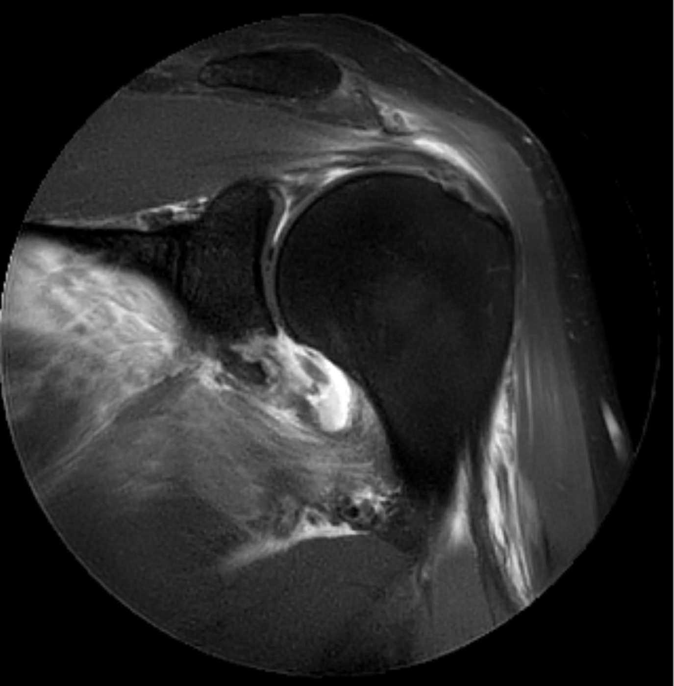 Figure 12. The same bony Bankart lesion on MRI (paracoronal proton-density fat-saturated) after an anteroinferior dislocation. Source: Hellerhoff, via Wikimedia Commons, CC BY-SA 3.0.