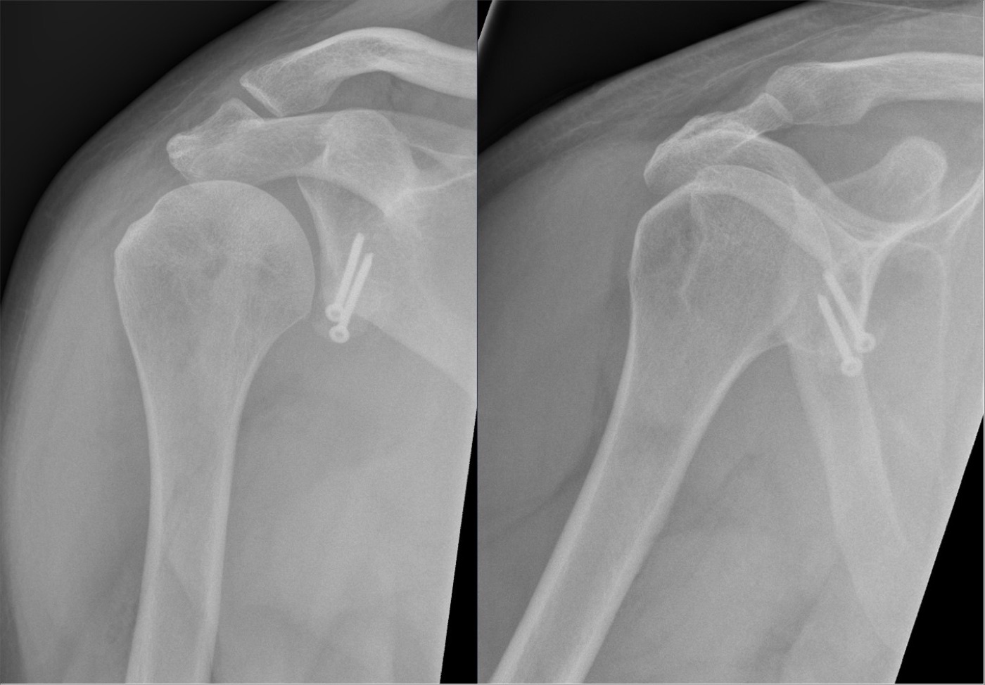 Figure 13. Latarjet procedure: the transferred coracoid bone block fixed to the anterior glenoid rim with two screws (postoperative radiographs). Source: Hellerhoff, via Wikimedia Commons, CC BY-SA 4.0.