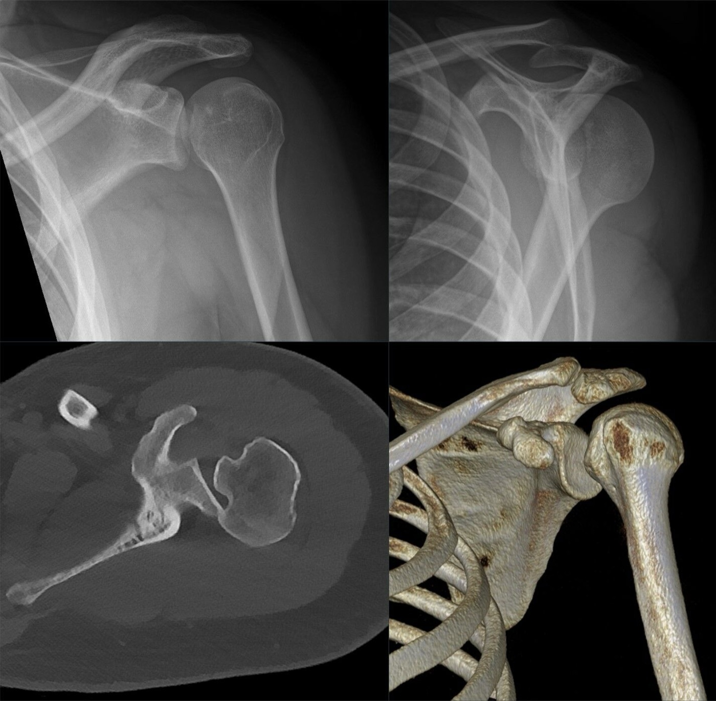 Figure 14. Posterior dislocation on CT: the humeral head displaced behind the glenoid (axial slice and 3D reconstruction), the displacement easily missed on the AP film. Source: Hellerhoff, via Wikimedia Commons, CC BY-SA 4.0.