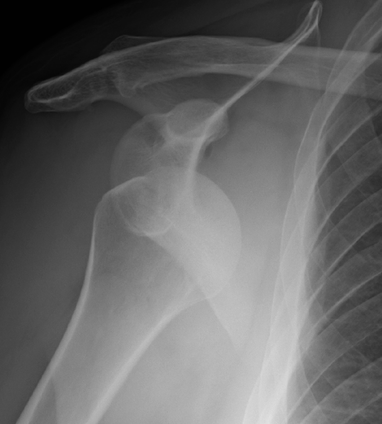 Figure 2. Anterior shoulder dislocation, AP radiograph: the humeral head lies anteroinferior to the glenoid (subglenoid/subcoracoid). Source: James Heilman, MD, via Wikimedia Commons, CC BY-SA 4.0.