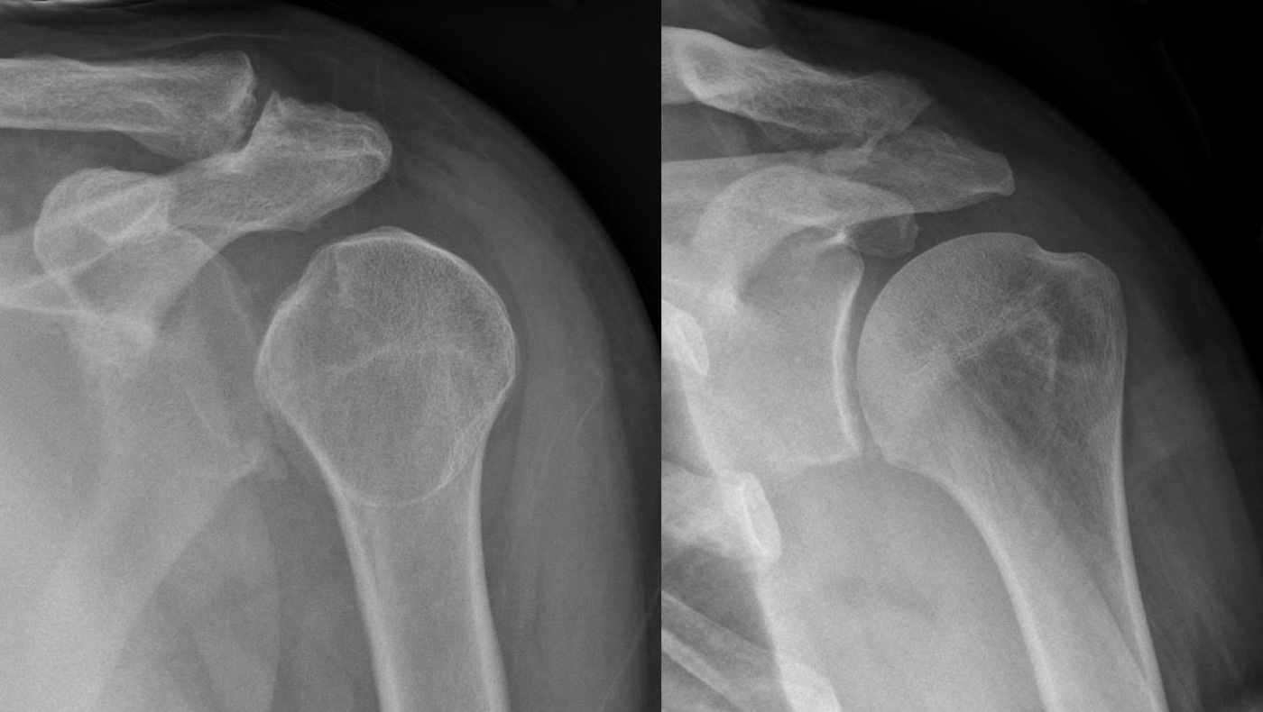 Figure 3. Posterior dislocation: fixed internal rotation makes the head look rounded and symmetrical, the “light-bulb” sign (left), shown with the same shoulder after reduction (right). Source: Hellerhoff, via Wikimedia Commons, CC BY-SA 3.0.