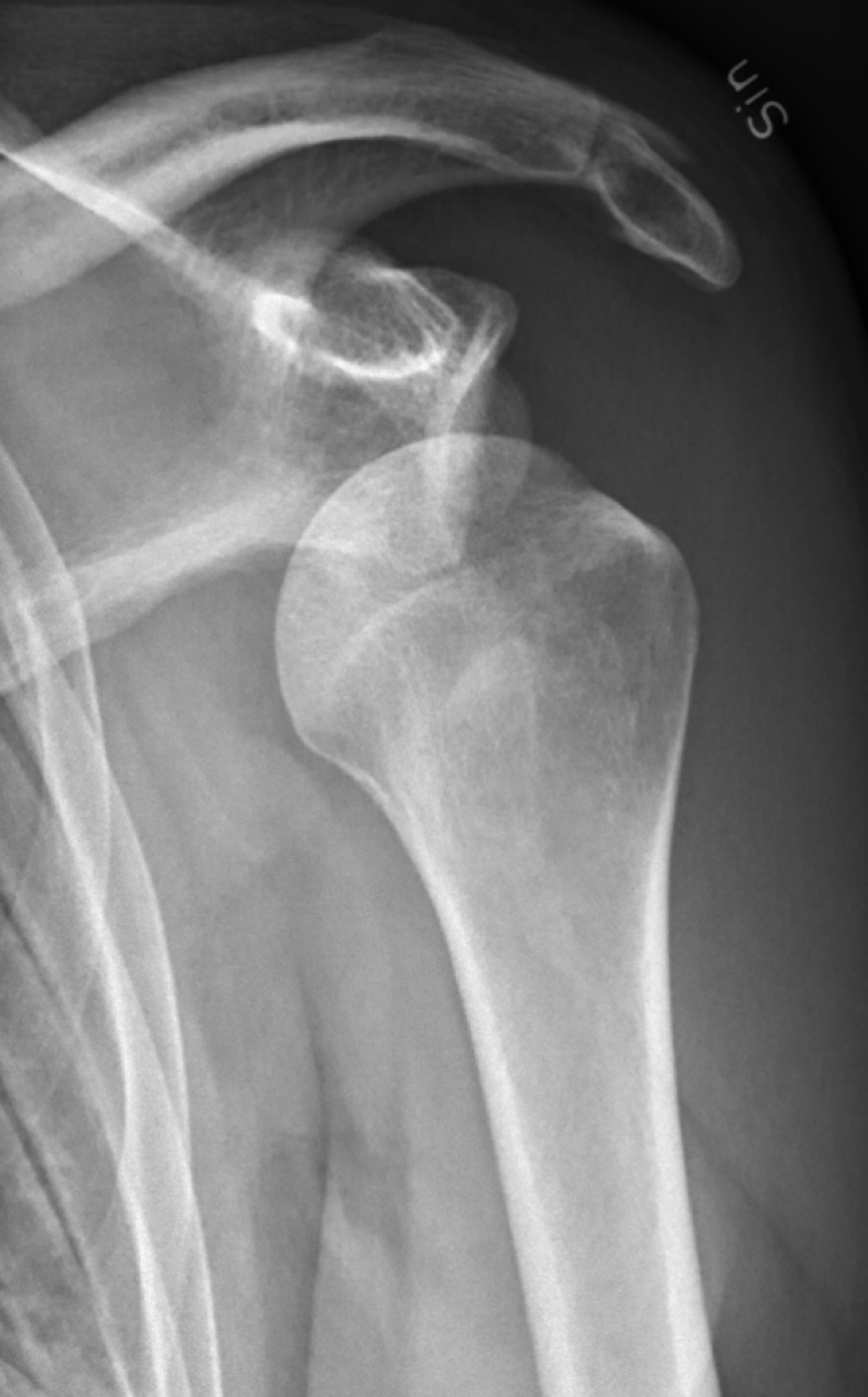Figure 5. Anterior dislocation before reduction. Source: Mikael Häggström, M.D., via Wikimedia Commons, CC0 1.0.
