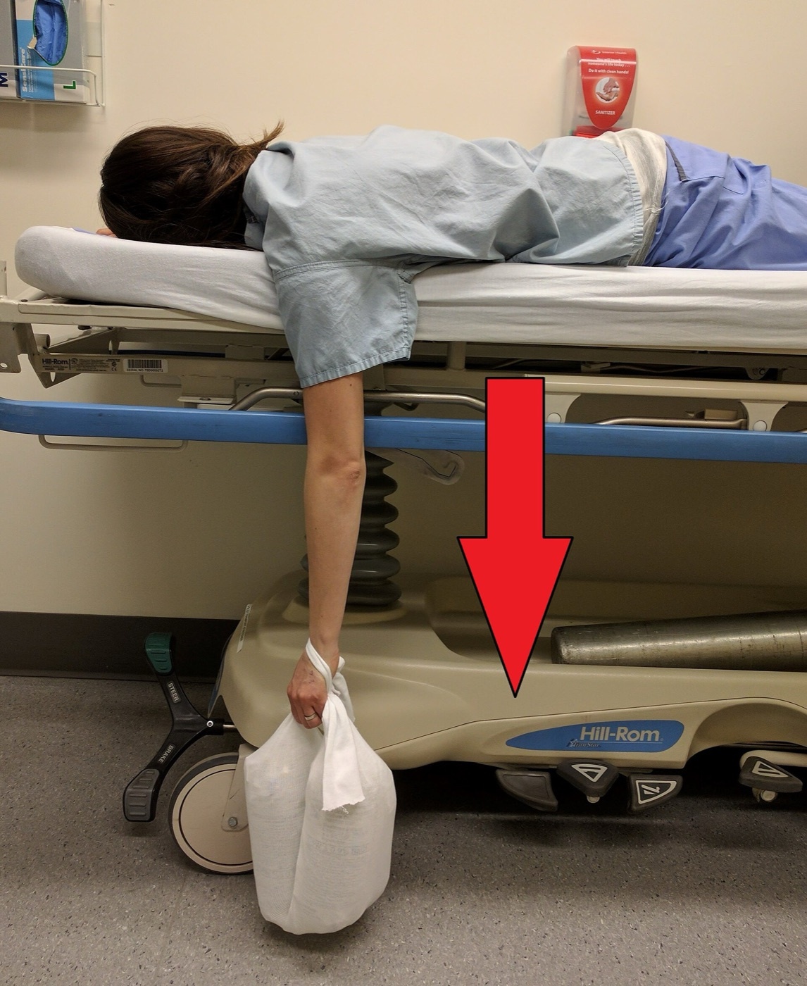 Figure 6. The Stimson reduction technique: the patient lies prone with the arm hanging and a suspended weight applying gentle downward traction. Source: James Heilman, MD, via Wikimedia Commons, CC BY-SA 4.0.