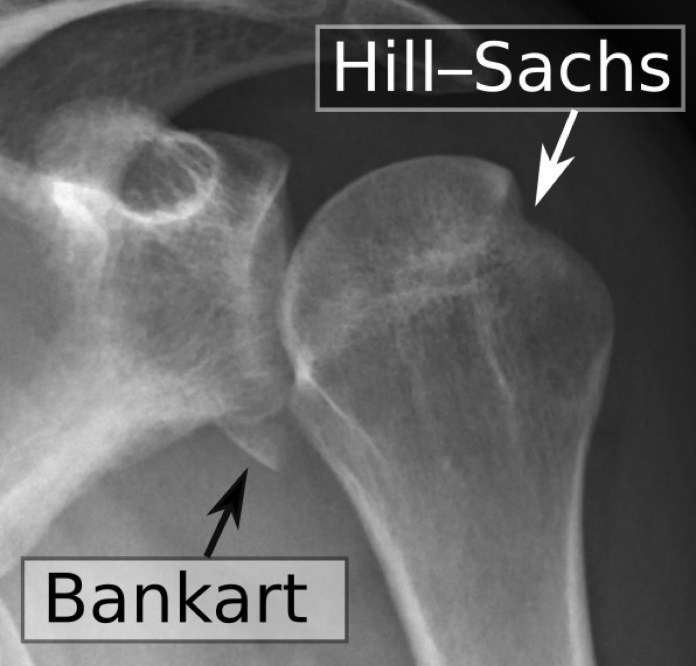 Figure 7. The same shoulder after reduction, with the annotated Bankart (anteroinferior glenoid) and Hill-Sachs (posterolateral head) lesions the dislocation produced. Source: Mikael Häggström, M.D., via Wikimedia Commons, CC0 1.0.