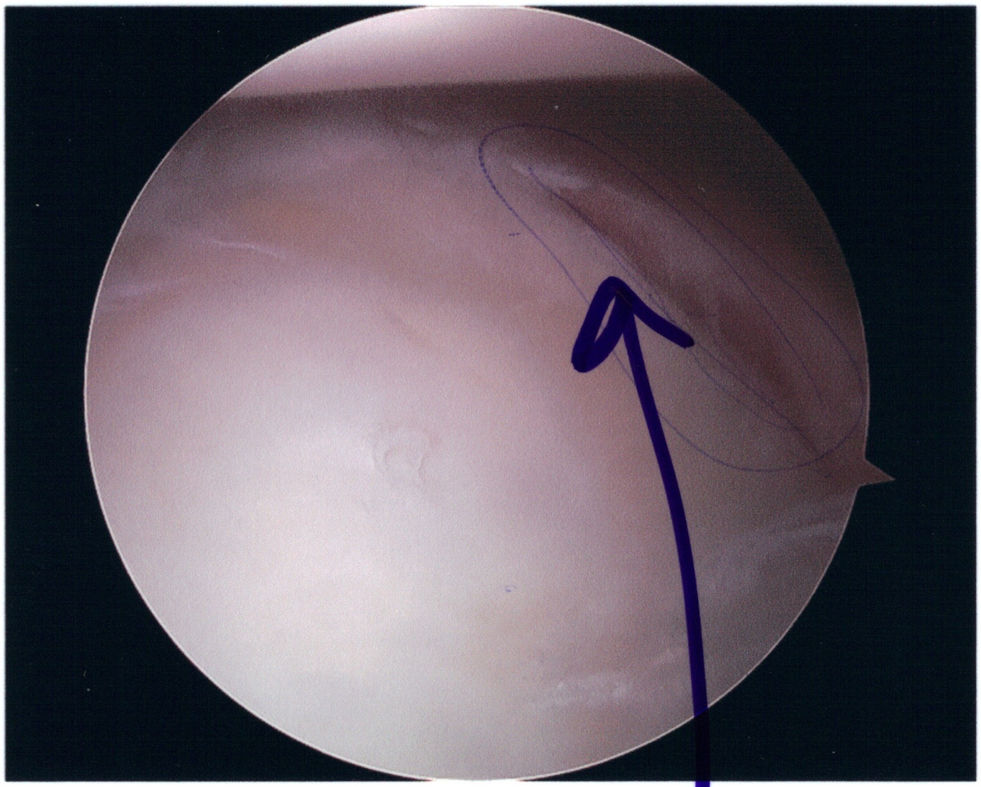 Figure 8. Bankart lesion at arthroscopy: the anteroinferior labrum detached from the glenoid rim (arrow). Source: Rwillia4, via Wikimedia Commons, public domain.