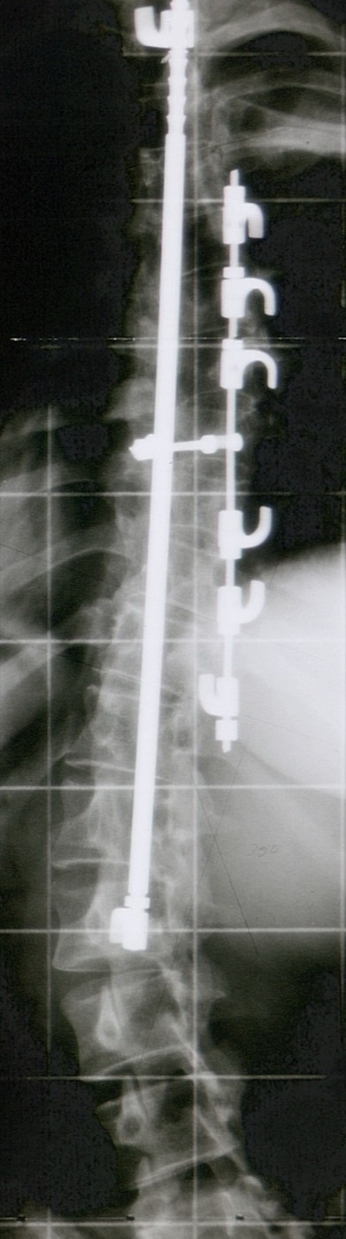 Figure 16. Radiograph after posterior spinal fusion for thoracic scoliosis, showing posterior (Harrington-rod) instrumentation. Mehlauge, CC BY-SA 3.0, via Wikimedia Commons.