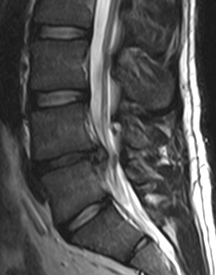 Figure 14. Sagittal lumbar MRI showing a disc extrusion at L4-L5 compressing the adjacent nerve root, the lesion the posterior approach is most often used to treat. Edave, CC BY-SA 3.0, via Wikimedia Commons.