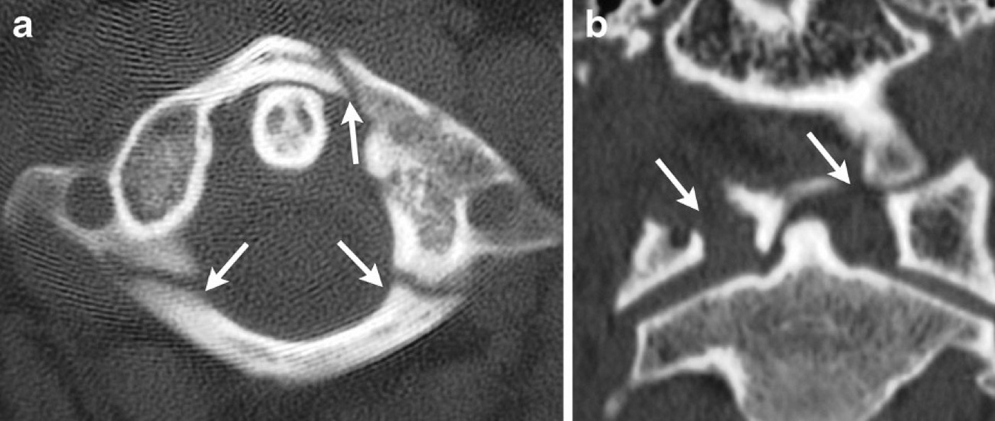 Figure 3. CT of a Jefferson (C1 burst) fracture: axial and coronal images with arrows marking the breaks in the anterior and posterior arches of the atlas. From Utz et al. (2013), Insights into Imaging 5(1):67-75, CC BY 4.0, via Wikimedia Commons.