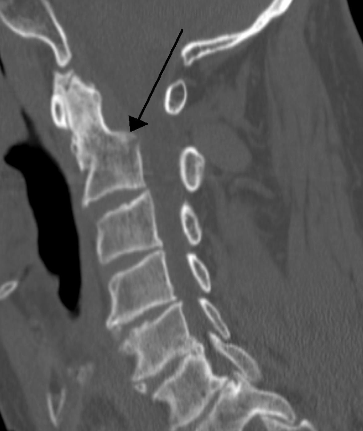 Figure 5. Sagittal cervical CT of a fracture through the base of the dens (arrow): a type II odontoid fracture, the high-nonunion pattern. Source: James Heilman, MD, via Wikimedia Commons, CC BY-SA 3.0.