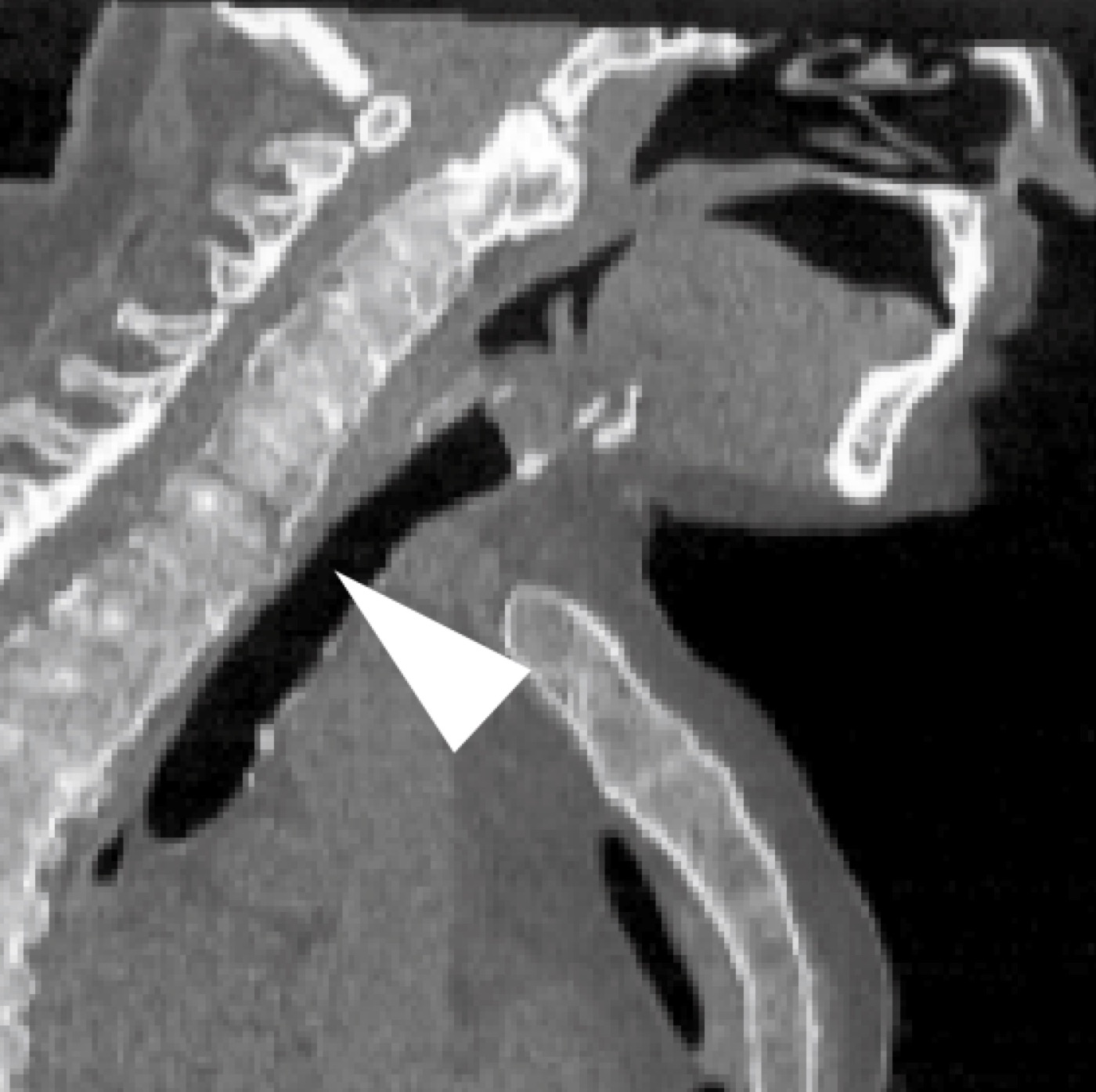 Figure 7. Sagittal CT of an ankylosed (bamboo) spine with a transverse fracture at the cervicothoracic junction: the highly unstable, long-bone-like fracture pattern of the stiff spine. (Used to illustrate an unstable transvertebral cervical pattern.) From Ushijima et al., CC BY 4.0, via Wikimedia Commons.