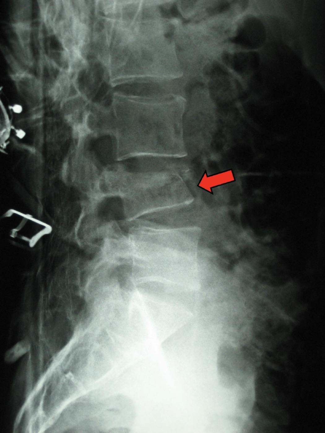 Figure 8. Lateral lumbar radiograph of a compression (wedge) fracture at L4 (arrow): anterior-column failure with an intact posterior cortex, the typically stable Denis compression injury. Source: James Heilman, MD, via Wikimedia Commons, CC BY-SA 3.0.