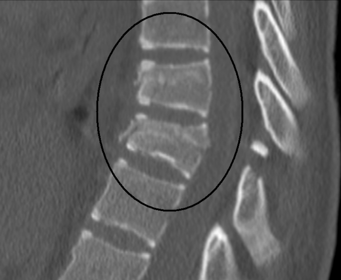 Figure 12. Sagittal CT of the same Chance fracture, showing the horizontal split running through the vertebra. Source: James Heilman, MD, via Wikimedia Commons, CC BY-SA 3.0.