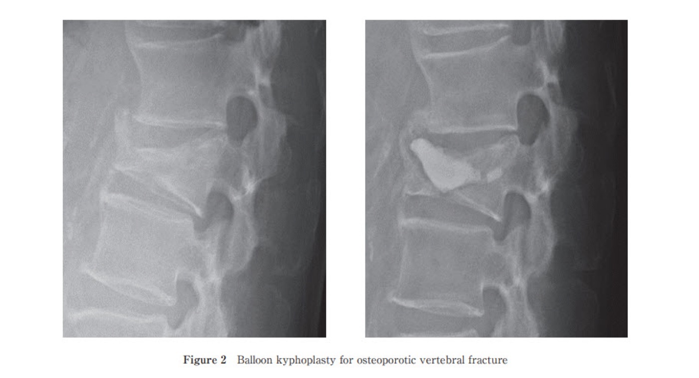 Figure 13. Balloon kyphoplasty for an osteoporotic vertebral compression fracture: before-and-after lateral radiographs with bone cement in the treated body. Current guidelines favour kyphoplasty over vertebroplasty. Source: Rei Momomura, via Wikimedia Commons, CC BY 4.0.