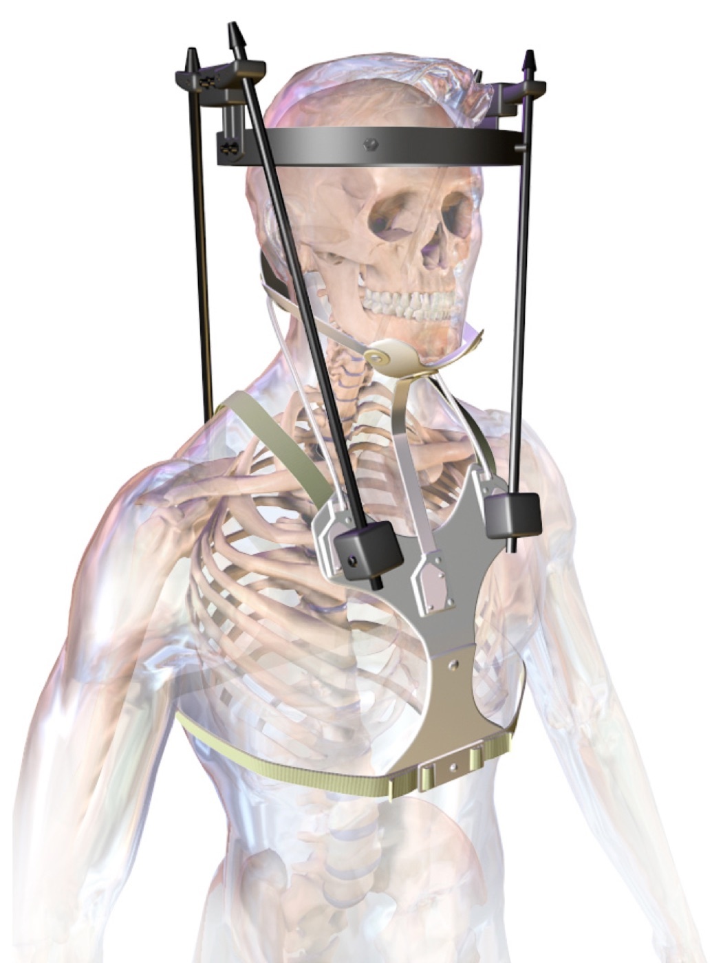 Figure 14. The halo vest (halothoracic orthosis): a cranial ring on skull pins linked by uprights to a thoracic vest, the most effective non-operative control of upper-cervical motion. Source: BruceBlaus, via Wikimedia Commons, CC BY-SA 4.0.