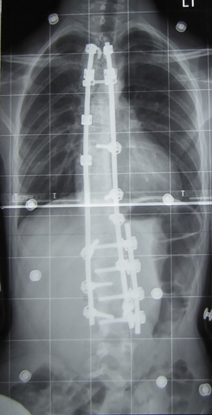 Figure 15. Posterior spinal instrumentation: pedicle screws and dual rods, the biomechanically superior construct for the thoracolumbar spine. (Illustrative post-fusion film of a deformity correction rather than a fracture.) Image by Wikipedia user Silverjonny, public domain, via Wikimedia Commons.
