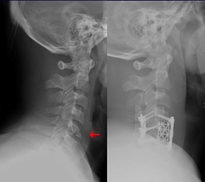 Figure 11. A lower cervical (teardrop) fracture before (left) and after anterior cervical discectomy and fusion with an interbody cage and anterior plate (right). By Moquito 17, CC BY-SA 3.0, via Wikimedia Commons.