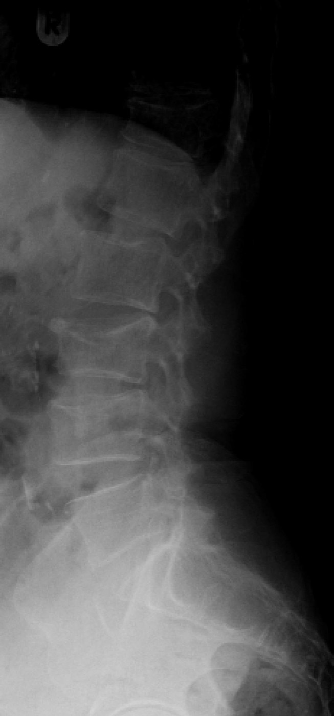 Figure 12. Lateral radiograph of a thoracolumbar compression (anterior wedge) fracture with preserved posterior body height; involvement of the anterior column alone distinguishes it from a burst fracture. Lucien Monfils, CC BY-SA 3.0, via Wikimedia Commons.