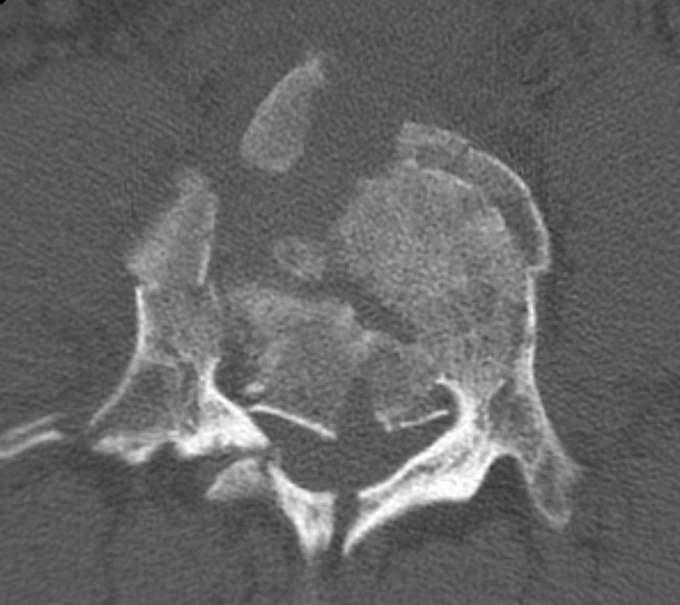 Figure 14. Axial CT of a lumbar burst fracture with comminution of the vertebral body and a retropulsed fragment narrowing the spinal canal. James Heilman, MD, CC BY-SA 4.0, via Wikimedia Commons.