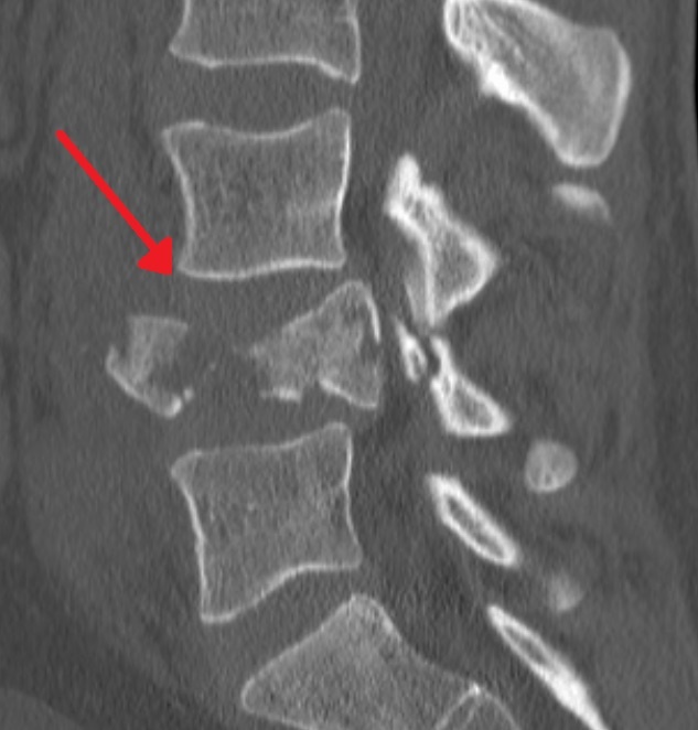 Figure 15. Sagittal CT of the same burst fracture showing loss of vertebral body height and posterior retropulsion into the canal. James Heilman, MD, CC BY-SA 4.0, via Wikimedia Commons.