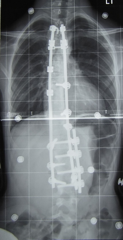 Figure 16. Postoperative radiograph after posterior pedicle-screw-and-rod instrumentation and fusion spanning the injured level. By Silverjonny, public domain, via Wikimedia Commons.