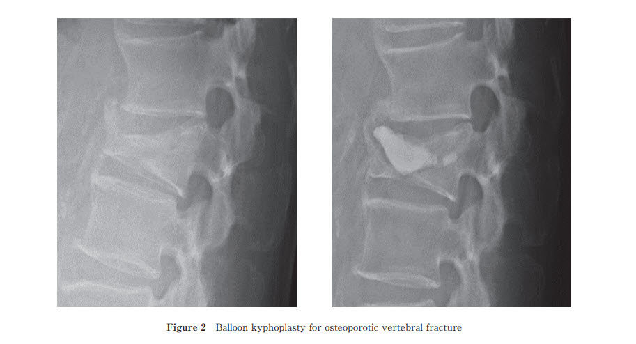 Figure 17. Osteoporotic vertebral compression fracture before (left) and after balloon kyphoplasty with cement augmentation (right). Rei Momomura, CC BY 4.0, via Wikimedia Commons.