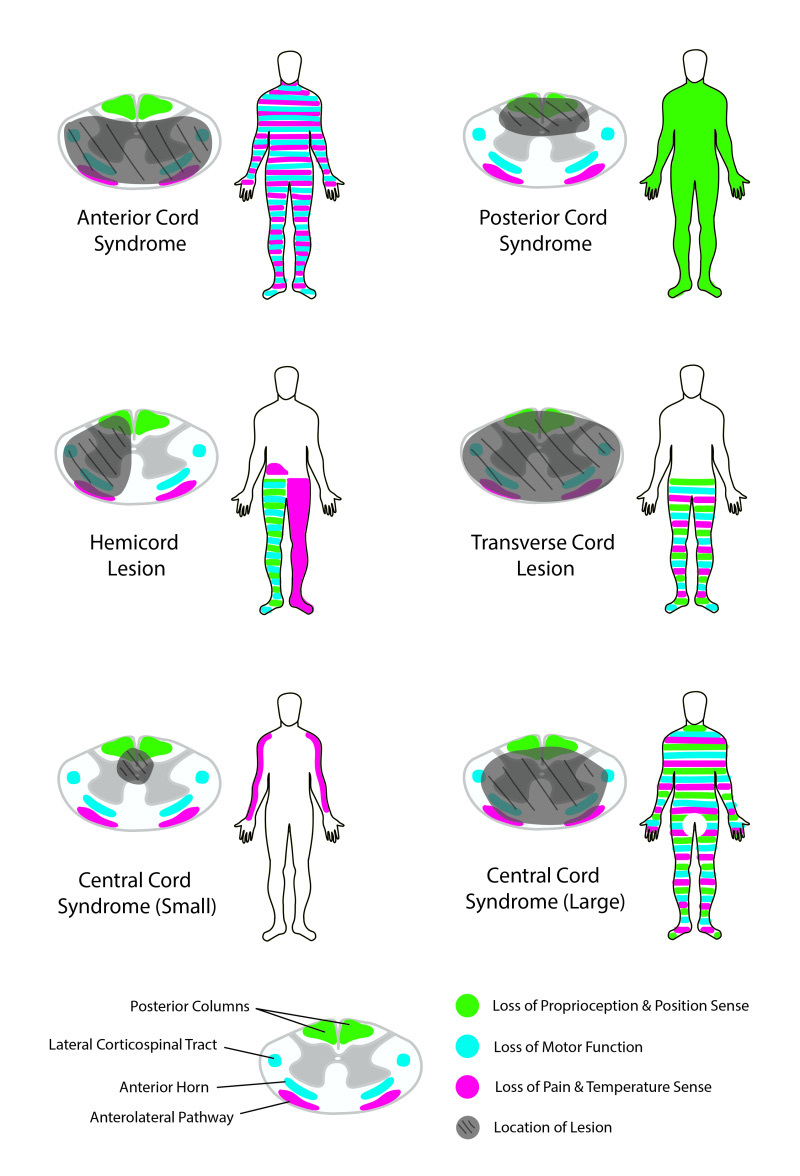 Figure 4. Patterns of incomplete spinal cord injury (anterior, posterior, central, Brown-Séquard and transverse lesions) with the cord cross-section location and the resulting sensorimotor deficits. Rian Kabir, CC BY 4.0, via Wikimedia Commons.