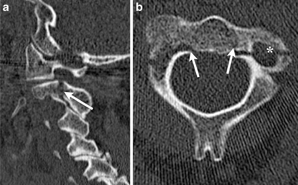 Figure 8. Hangman’s fracture (traumatic spondylolisthesis of the axis): sagittal CT shows the bilateral C2 pars fracture with anterolisthesis of C2 on C3, confirmed on the axial image. Utz et al., CC BY 4.0, via Wikimedia Commons.