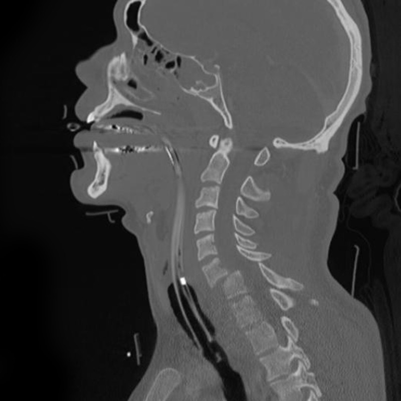 Figure 9. Sagittal CT of a C6-C7 cervical fracture-dislocation with anterolisthesis, the bony correlate of jumped facets. Frank Gaillard (Radiopaedia), CC BY-SA 3.0, via Wikimedia Commons.