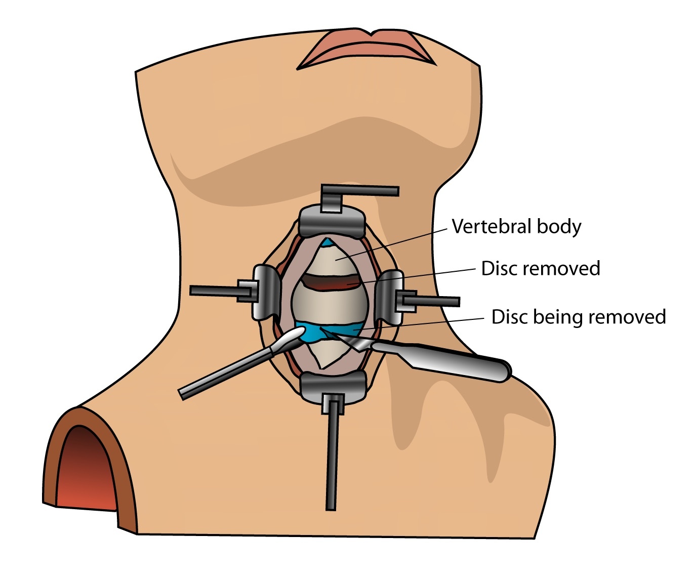 Figure 10. Anterior cervical discectomy and fusion (ACDF): the disc is removed through an anterior approach before interbody grafting and plating, addressing anterior compression. By debivort, CC BY-SA 3.0, via Wikimedia Commons.